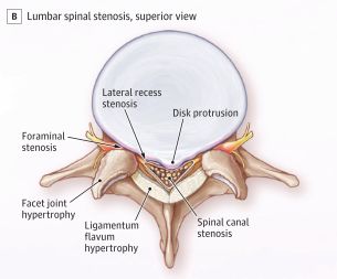 TDekkersPhysio's tweet photo. Spinal Stenosis Part 1: Anatomy of the problem 🧵

Spinal stenosis isn't one structure pressing on a nerve.

It's three tissues closing in on the same space, in sequence. https://t.co/nGSOnsunKN