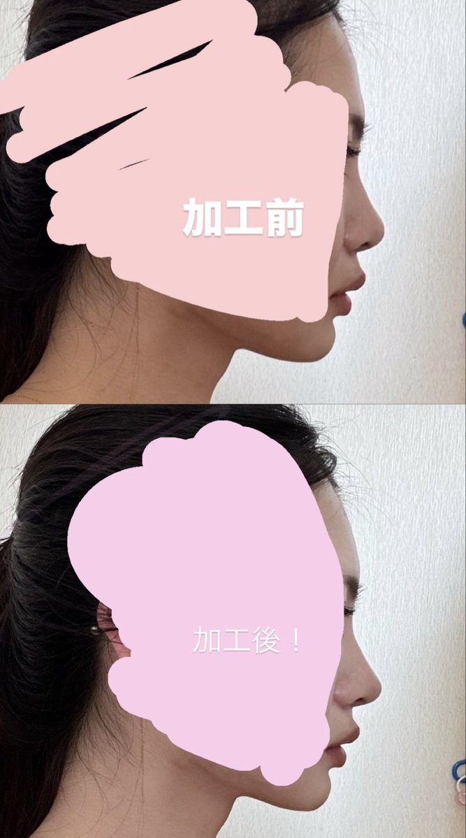 pookidooonn's tweet photo. ・鼻尖溝の影の入り方を菱形に
・横から見た鼻柱と鼻尖の長さの比は1:1に
・四角形鼻
・鼻先のトップの位置は小鼻上部との水平線上に
・鼻唇角をどの方向にどの角度で
・小鼻のアウトラインはハの字に
・眉骨が出てるため鼻根を高く
・ナジオンの位置は目と目の間

👆🏻みたいに伝えた！

けど言語も美的センスも違うし言葉だけじゃ分かりにくいから、自分の写真を加工したものを持っていくのが一番！！
どの病院行ってもそれが一番ありがたいって言われるよ🫶🏻

私は下の写真と動画を見せてた