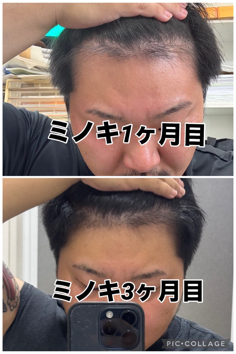 ysti0922's tweet photo. 禿げてきたみんなまだ間に合うよ！
フィナステリド2年（現在も継続）
リアップ（ミノキシジル）3ヶ月
の結果 https://t.co/BUaaDZLF04