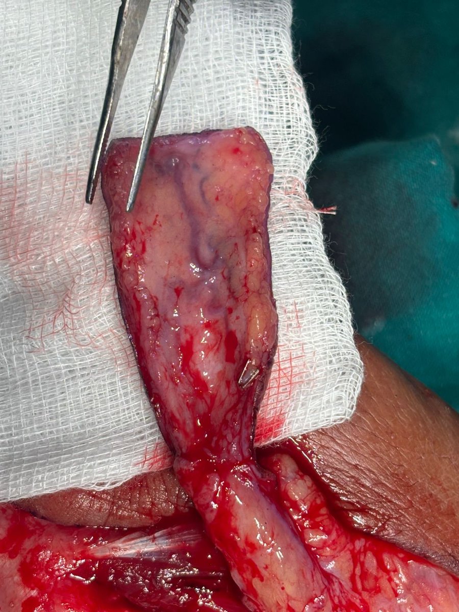 drsonipavan's tweet photo. The FDMA flap is usually meant for dorsal defects, we temporarily fixed the IPJ in flexion for reach. https://t.co/ZpS8hAqhP6