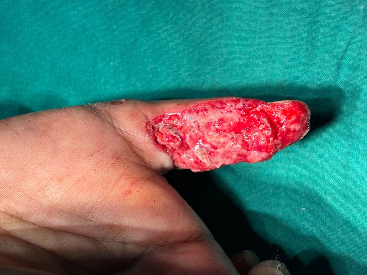 drsonipavan's tweet photo. The FDMA flap is usually meant for dorsal defects, we temporarily fixed the IPJ in flexion for reach. https://t.co/ZpS8hAqhP6