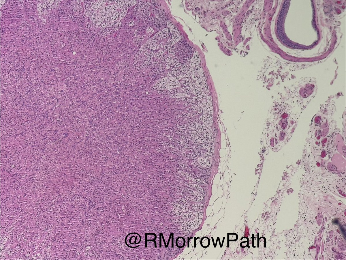 RMorrowPath's tweet photo. So I found this little cutie hanging out in the paratubal space. Remind you of another organ somewhere? Perhaps one that that works overtime on a stressful day? 
💥Diagnosis please dr!! 
#gynpath #pathology https://t.co/ho7vCQyMPj