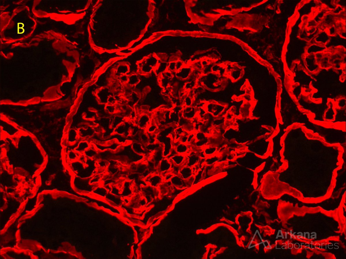 arkanalabs's tweet photo. X-linked Alport syndrome is caused by COL4A5 gene mutations. These mutations result in abnormalities of the glomerular basement membrane (GBM) and kidney disease. The photomicrographs below show staining of kidney biopsies for collagen type IV alpha 2 chain (COL4A2) with a red fluorophore and collagen type IV alpha 5 (COL4A5) with a green fluorophore as a test for Alport syndrome. Photomicrograph A shows a normal glomerulus with staining of GBMs and Bowman’s capsule for COL4A2 and COL4A5 in an uninterrupted pattern. Photomicrograph B is from a male patient with Alport syndrome. The positive COL4A2 staining confirms tissue integrity while the COL4A5 is completely negative, confirming the diagnosis of Alport syndrome. Photomicrograph C is from a female who is heterozygous for X-linked Alport syndrome. The positive staining for COL4A2 allows visualization of GBM segments that are negative for COL4A5. Immunohistochemical evaluation for COL4A5 is a specific but not entirely sensitive assay for the detection of Alport. Therefore, normal staining in a kidney biopsy does not exclude the possibility of disease.

#TeachingPoints #kidneypath #renal #pathology