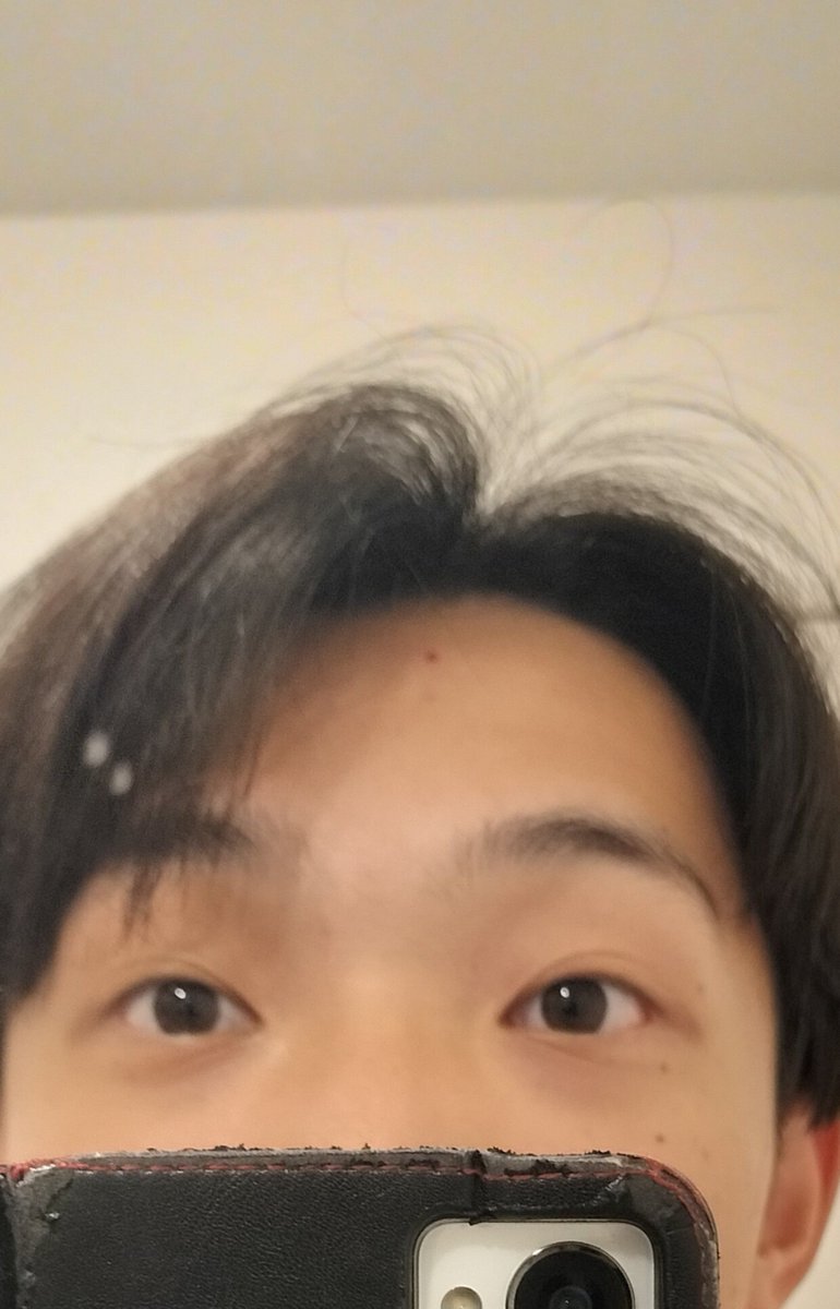 u_kk111's tweet photo. ニキビ破壊したら血が出てきて楽しい https://t.co/fVuhXxzXhA