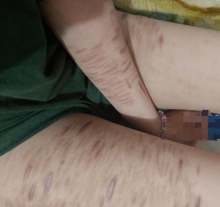 loriee243555's tweet photo. i love my scars sm
#shedrtwt #shtwt #edrtwt #ouchietwt #fakebody https://t.co/aBTbpHSThO