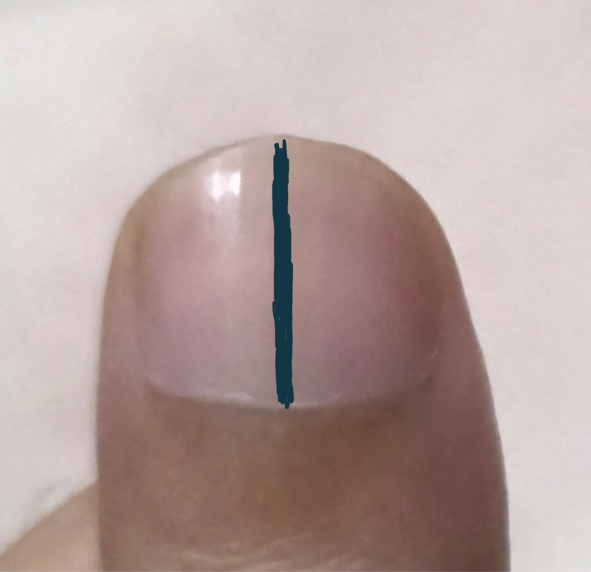 DocPriyamMD's tweet photo. Before ordering a scan or blood test, doctors still look at the nails. Cancer, lung disease, severe iron deficiency, heart infection and kidney disease can all leave clues there.

Most changes are harmless. These five deserve a closer look:

1. A DARK LINE WIDENS https://t.co/XTXWdpl9pZ