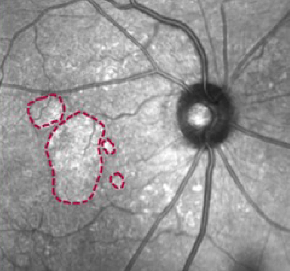 revoptom's tweet photo. Earlier Treatment May Preserve More Retinal Tissue in Geographic Atrophy

Starting pegcetacoplan therapy sooner led to greater preservation of retinal tissue and lower risk of central scotoma over 48 months.
https://t.co/m3scGKfeuc

#optometry #retina #geographicatrophy #AMD https://t.co/8Jy00dqL2B