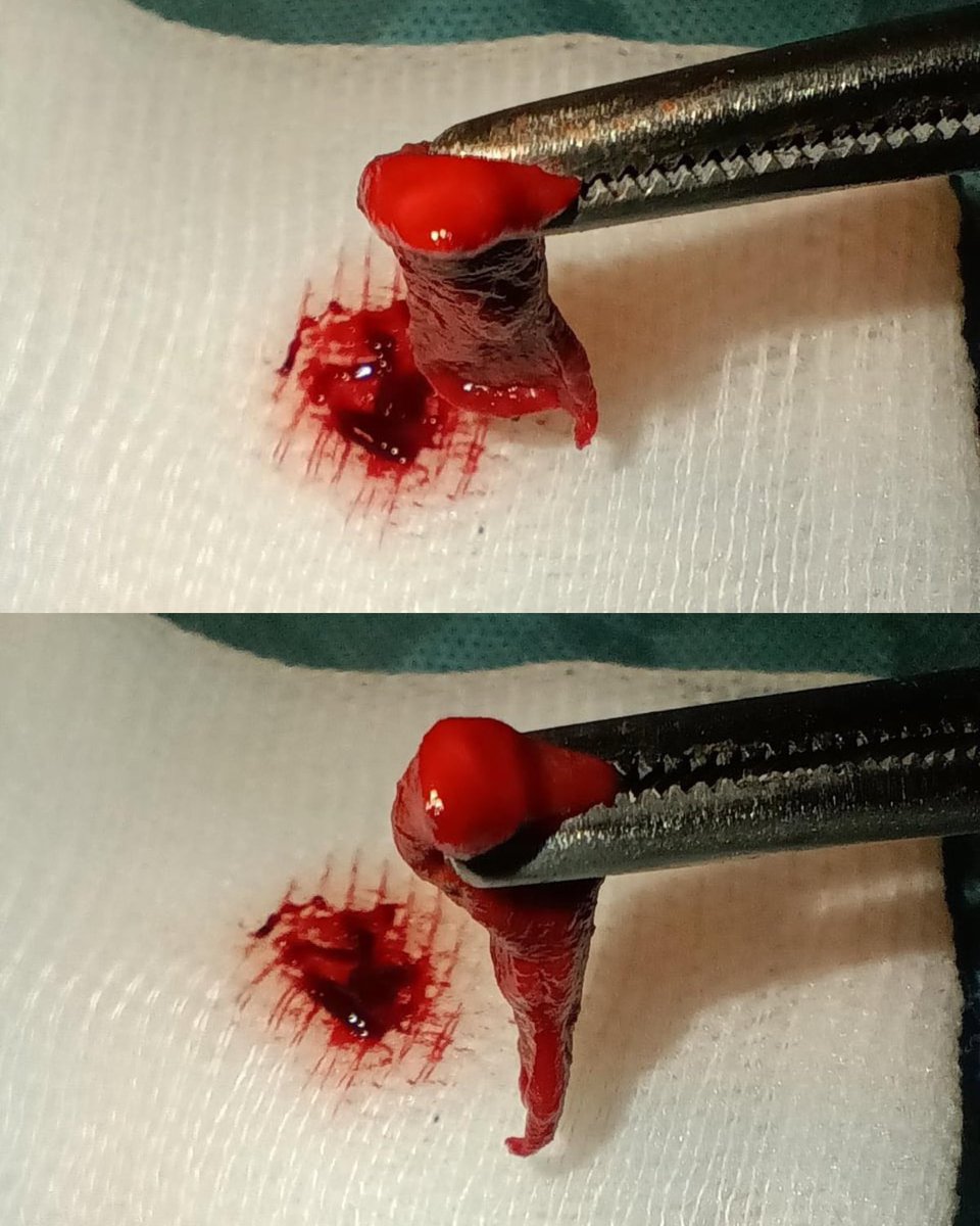anatomie_x's tweet photo. Bei einer Frau löst sich seit ihrer ersten Periode jeden Monat die Gebärmutterschleimhaut nahezu vollständig als zusammenhängender sogenannter Dezidualabguss ab.Die Ursache ist bislang unklar. Fotos sollen nun helfen, die ungewöhnliche Erscheinung gynäkologisch genauer abzuklären https://t.co/eTtcunInLp