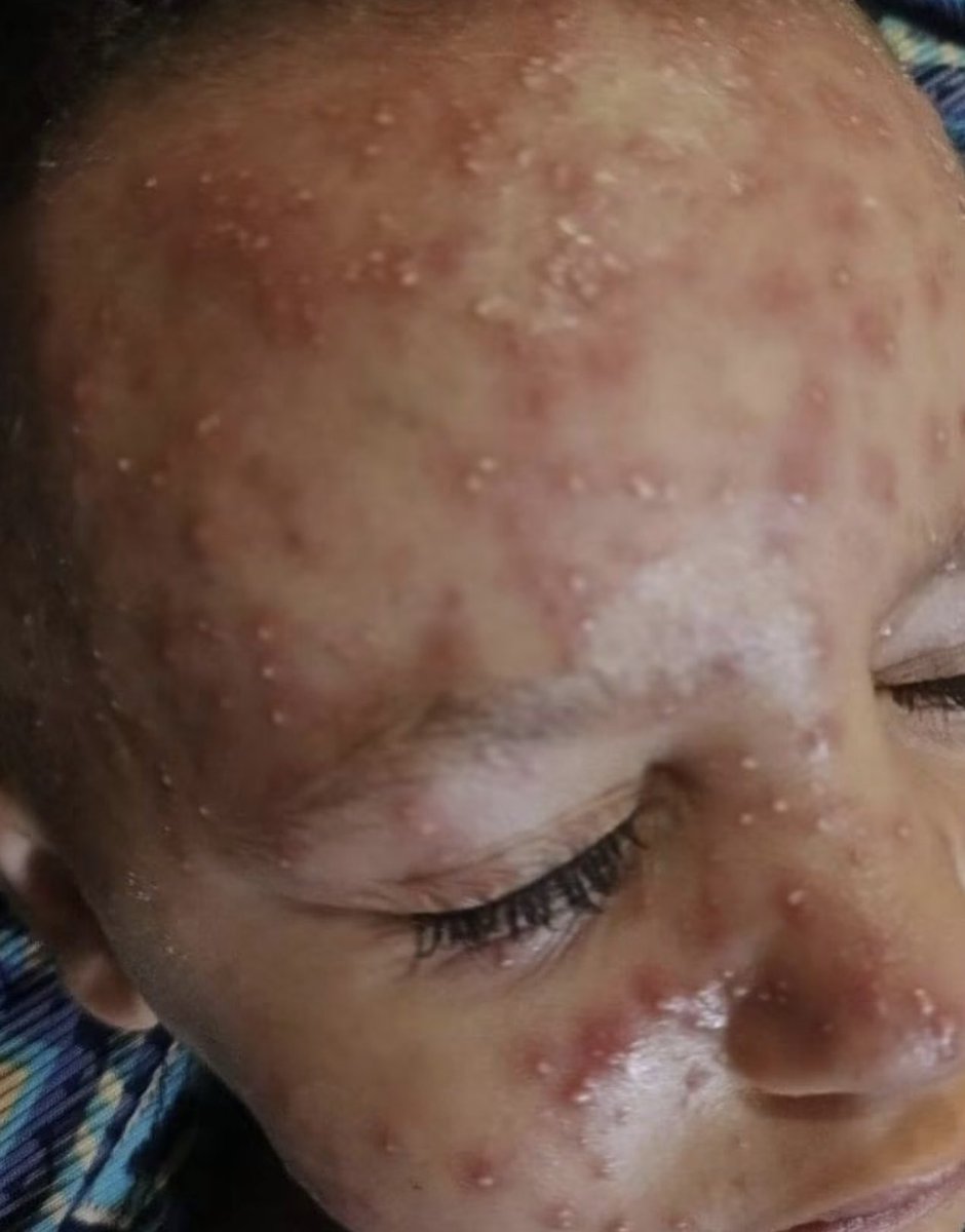 DanielSeddon2's tweet photo. Medicines are unavailable.
Skin diseases are plaguing children in the Gaza Strip for several reasons, including water contamination.
Do you support Palestine?
• Yes
.No
Children of Gaza. #GazaGenocide‌‌ #Gaza #GazaUnderAttack #freepalestine #FreeGaza #GazaChildren #supportgaza https://t.co/5a9E57IYed