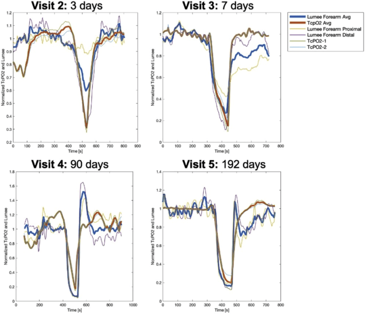 DGArmstrong's tweet photo. Monitoring Tissue Oxygen Dynamics with a Novel Implantable Hydrogel Sensor in Patients with Peripheral Arterial Disease @vascularsvs #VAM22 @UCSFVascular #C2SHiP @profusainc https://t.co/2Ts69kEVlL https://t.co/bLdaW4eSSS
