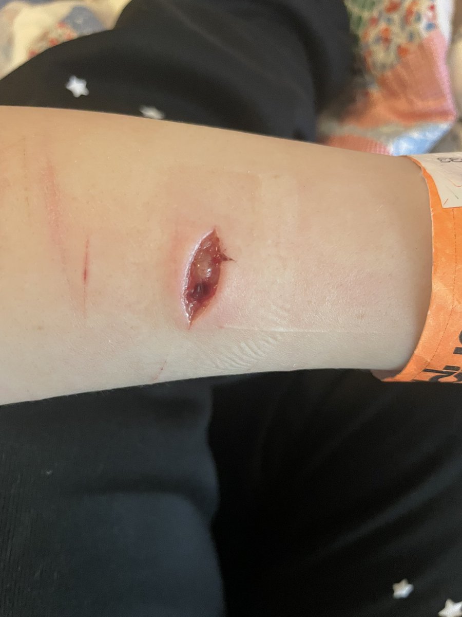 cuddlepuppyblu's tweet photo. Hit beans for the first time Christmas Day had to get stitches but it’s coo #Shtwt #blowup #beans https://t.co/yfIKUIE2K3
