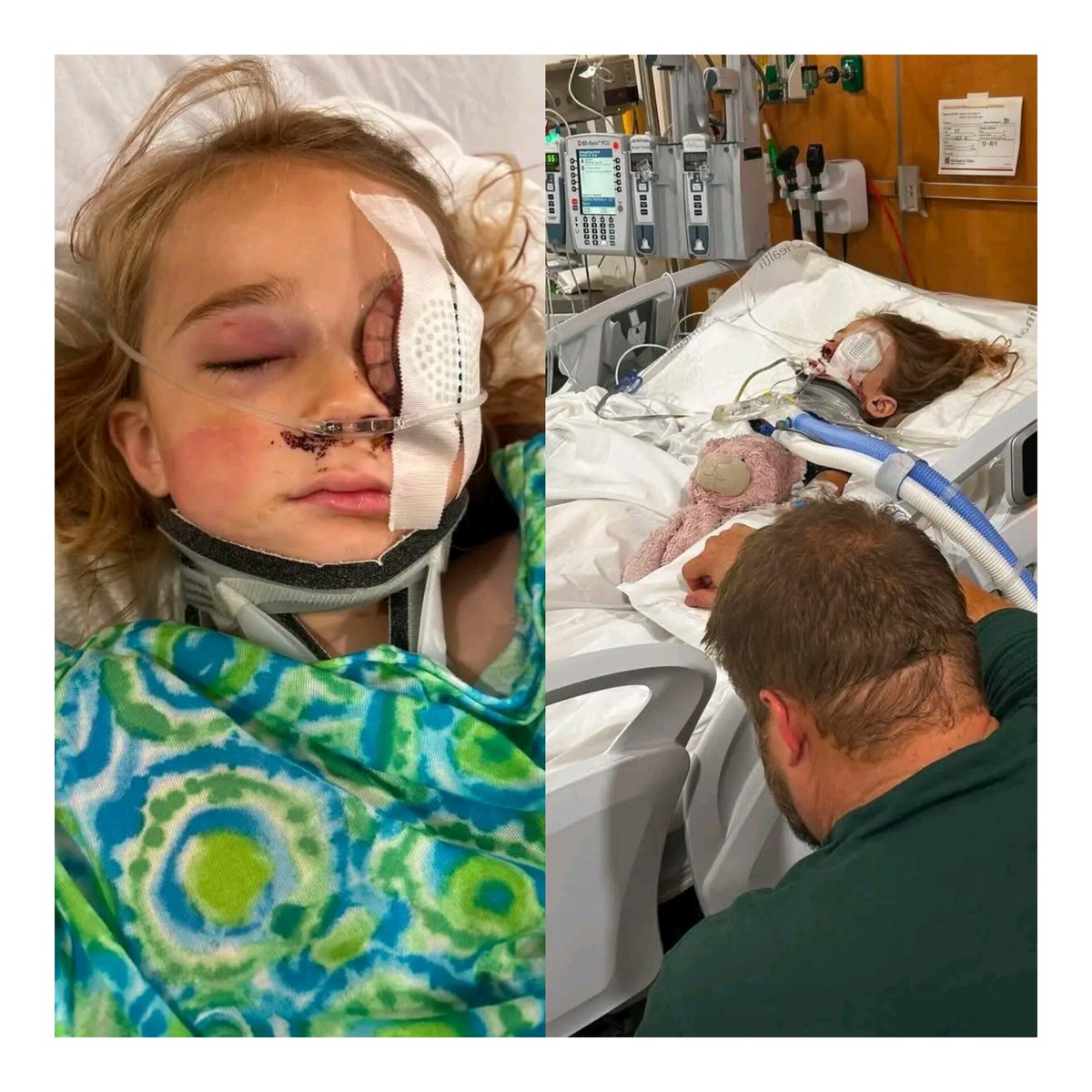 AdaugoAguiyi's tweet photo. Our hearts go out to the Mallie Williams family

Jared and Angela Williams have a six-year-old daughter, Mallie. Jared is a pastor in Tipton, Indiana. 

This past Thursday, August 27, Jared was out mowing his lawn while Mallie played in a far corner away from the mower. Something flew out from under the mower and hit Mallie on the left side of her face. It sliced from her nose up. They took her to emergency for what they thought was just stitches. 

A CT-scan showed the eye was also sliced with pieces of it missing. A piece of her brow bone broke off and pierced her brain. Mallie has undergone multiple surgeries. The doctors tried to save her left eye but couldn’t. Yesterday, they were able to take the tube out from her being intubated and placed her in a hospital room, out of ICU.

Please pray for Mallie and the Williams family in this sudden devastating tragedy. They are trusting God for the outcome. As I see updates, I will try to share. 

Source: Shelly Hamilton