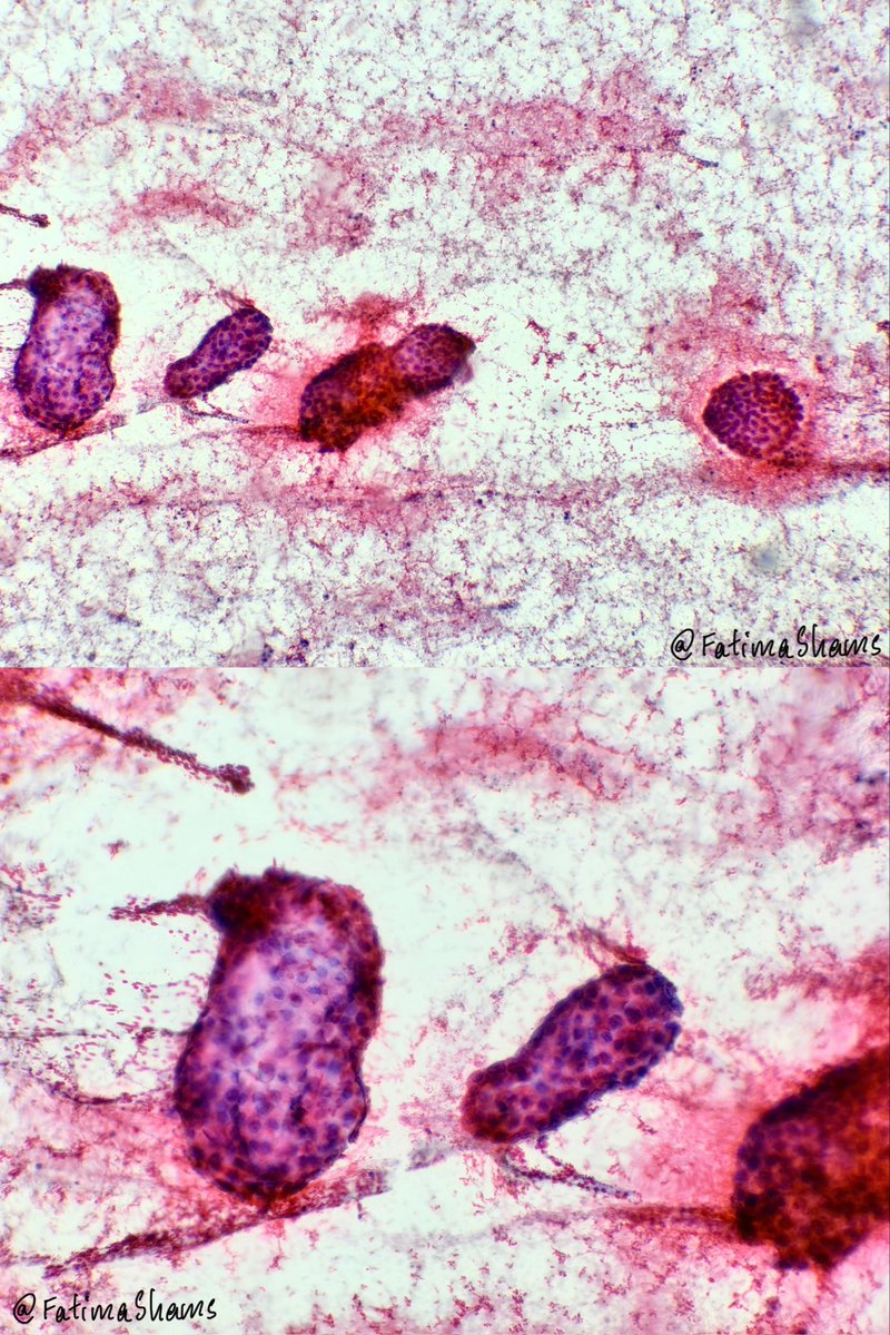 FatimaShamsPath's tweet photo. 📣 CYTOLOGY - PERICARDIAL EFFUSION
 
👉 64 YO male presenting with seizures, massive pericardial effusion and cardiac tamponade.

DQ, pap, cell block and IHC provided.
 
What is your diagnosis ⁉️
 
#Cytology #PericardialEffusion #EffusionCytology #Pathology #PathTwitter #ThoracicPathology