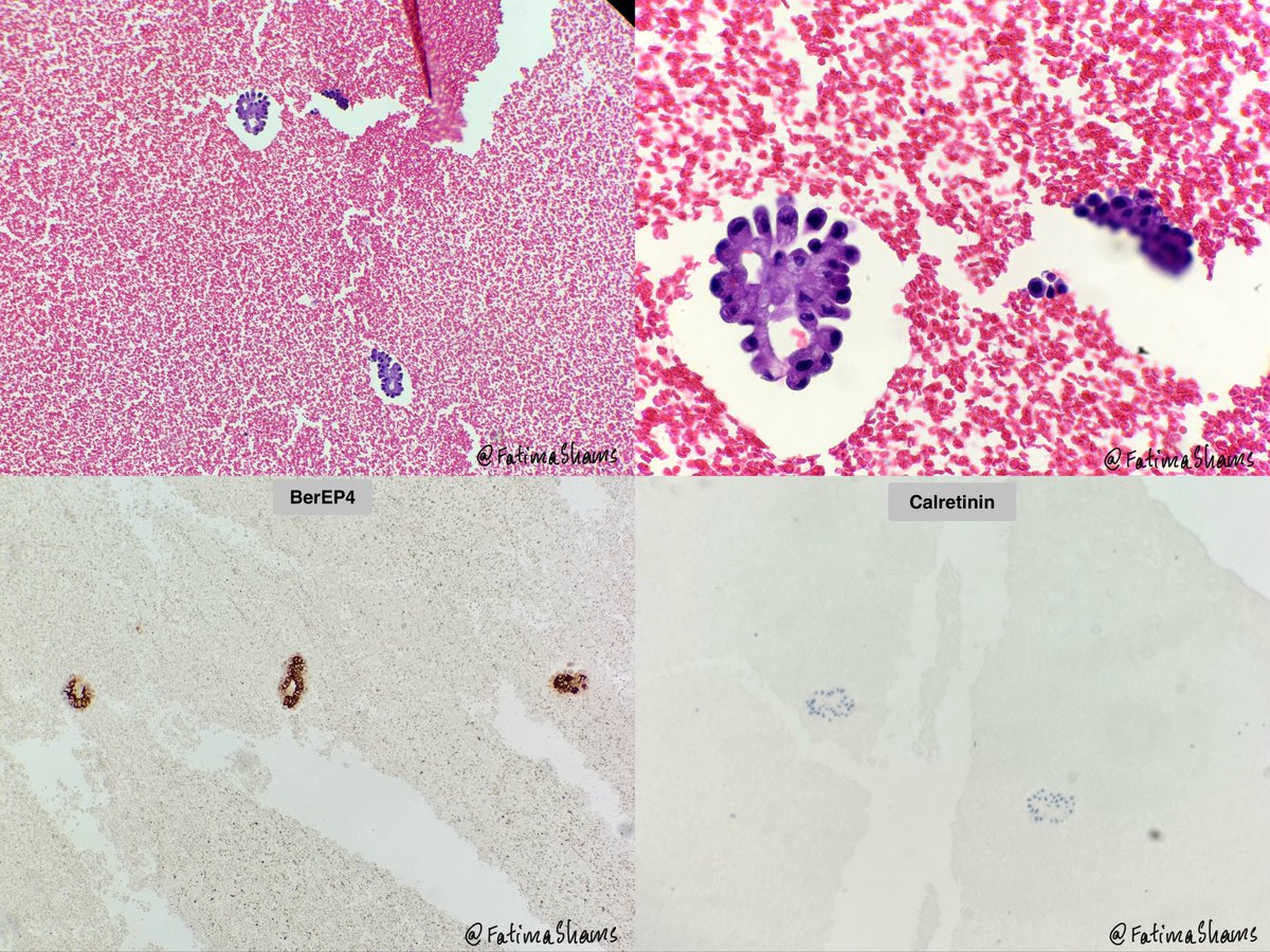 FatimaShamsPath's tweet photo. 📣 CYTOLOGY - PERICARDIAL EFFUSION
 
👉 64 YO male presenting with seizures, massive pericardial effusion and cardiac tamponade.

DQ, pap, cell block and IHC provided.
 
What is your diagnosis ⁉️
 
#Cytology #PericardialEffusion #EffusionCytology #Pathology #PathTwitter #ThoracicPathology
