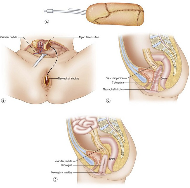 Santhi36749's tweet photo. @okularnik125 @hatepdfs They make the "vagina" from part of the colon... "colovaginoplasty" https://t.co/ixwIdmmdyX