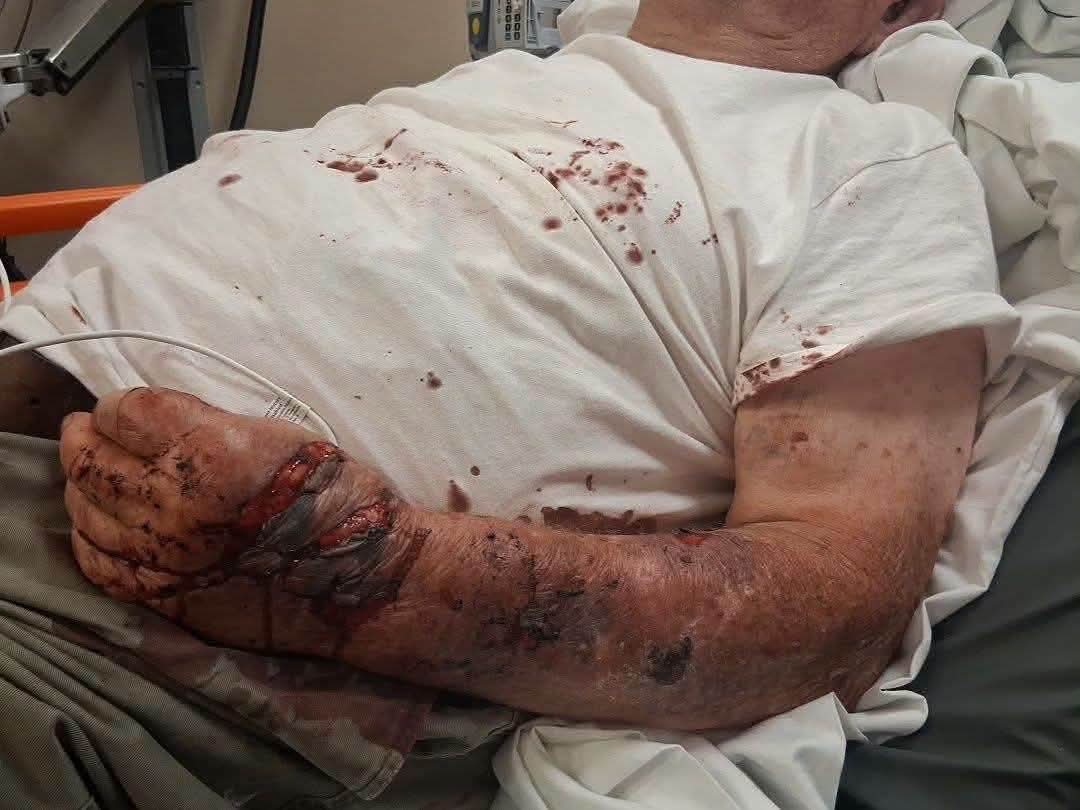 IAmyLeigh's tweet photo. 🚨An 84-year-old man in Lancaster, Kentucky, is recovering from severe injuries following an encounter with local police at his own front door.

​Ronald Maples a hard-of-hearing, longtime church member
went to answer his door after hearing officers knocking. 

According to his family, as he attempted to open the screen door, an officer yanked it open, causing him to lose his balance. Officers then forcefully took him to the ground.

​Maples left his porch with a fractured jaw, four broken vertebrae, shredded hands, and extensive facial bruising. Following the incident, authorities charged the 84-year-old with assault and resisting arrest.

​Location: Lancaster, Garrard County, KY

​Victim: Ronald Maples, 84
​Injuries: Fractured jaw, four broken vertebrae, lacerated hands, severe facial bruising

​Current Status: Charged with assault and resisting arrest; officers involved have been placed on suspension.

​Calls for Transparency and Action
Community members and family are calling for full public accountability, demanding the release of all bodycam footage and a fully transparent investigation rather than internal reviews.

​#PoliceAccountability #LancasterKY #RonaldMaples #ExcessiveForce #ElderAbuse #Bodycam #HoldThemAccountable #CivilRights #UseOfForce #Kentucky #GarrardCounty #DemandAccountability #TransparencyNow