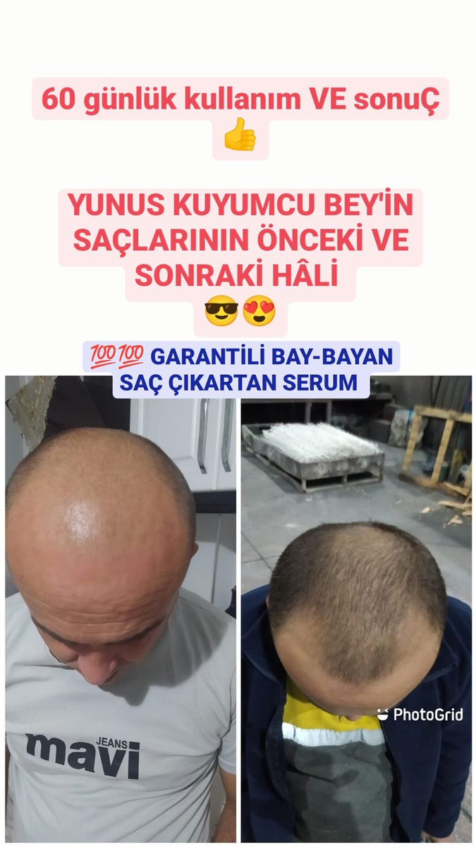 mavvilosyon's tweet photo. HAYIRLI SABAHLAR 

🔥BAY-BAYAN SAÇ ÇIKARTAN SERUM 👍
⚡ 💯💯 GARANTİLİ LOSYON ⚡

✅ GÜÇSÜZ, CANSIZ 
✅ ZAYIF
✅ SEYREK ve 
✅ DÖKÜLEN SAÇLARINIZIN YENİDEN ÇIKSIN😎
👉Düzenli kullanımda 1-1,5 ayda %100 farkını görüyorsunuz 
👉 Bir şişe 60 ml 1 ay gidiyor 👍 https://t.co/a0oj4mXJkf