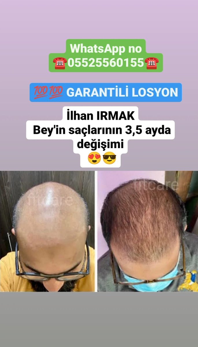 mavvilosyon's tweet photo. HAYIRLI SABAHLAR 

🔥BAY-BAYAN SAÇ ÇIKARTAN SERUM 👍
⚡ 💯💯 GARANTİLİ LOSYON ⚡

✅ GÜÇSÜZ, CANSIZ 
✅ ZAYIF
✅ SEYREK ve 
✅ DÖKÜLEN SAÇLARINIZIN YENİDEN ÇIKSIN😎
👉Düzenli kullanımda 1-1,5 ayda %100 farkını görüyorsunuz 
👉 Bir şişe 60 ml 1 ay gidiyor 👍 https://t.co/a0oj4mXJkf