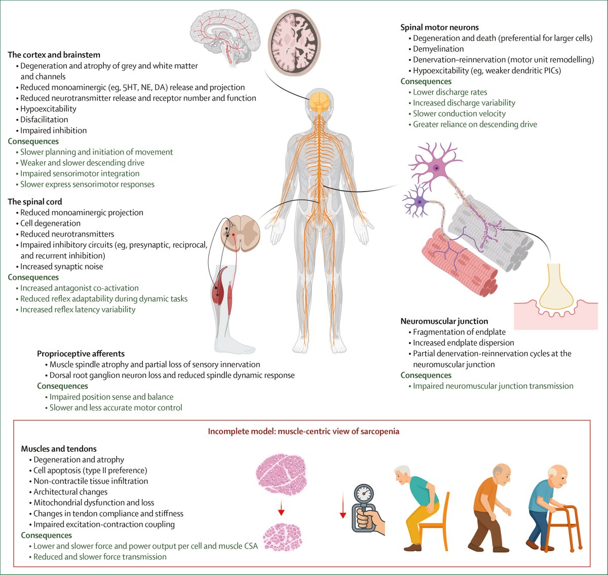 a_garciahermoso's tweet photo. 🚨 Cambio de paradigma en sarcopenia 🧠💪

¿Y si no fuera solo una enfermedad muscular?

👉Proponen entenderla como una enfermedad del sistema motor envejecido: cerebro, médula, nervios y músculo

🎯No basta preservar masa: fuerza y función importan más

https://t.co/O45qQcWztG https://t.co/YffTP86Rsc