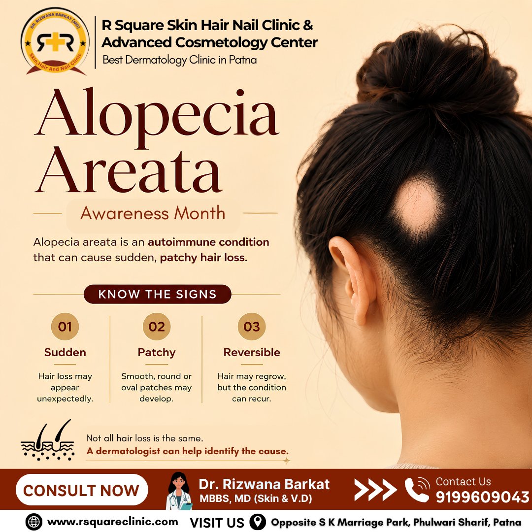 RNail49714's tweet photo. ✨ Not all #hairloss looks the same. And sometimes, it starts with just one patch.

#September is #Alopecia Areata Awareness Month — a time to understand this autoimmune condition and recognize its signs. 🌿

Sudden hair loss and smooth round patches deserve attention. 🔍 https://t.co/VO4UrObhKi