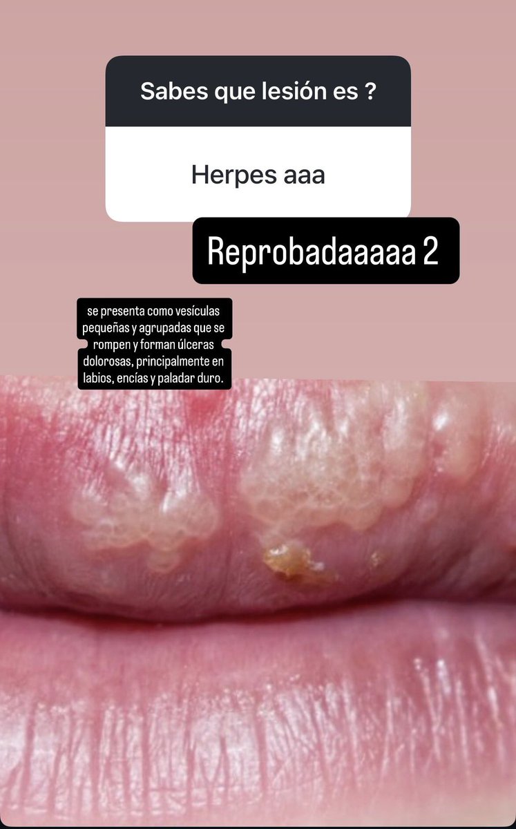 yeyabugarin's tweet photo. Un poquito de patología bucal https://t.co/QwB9yMHNOl
