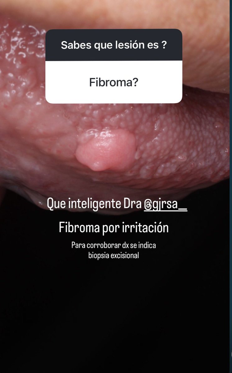 yeyabugarin's tweet photo. Un poquito de patología bucal https://t.co/QwB9yMHNOl