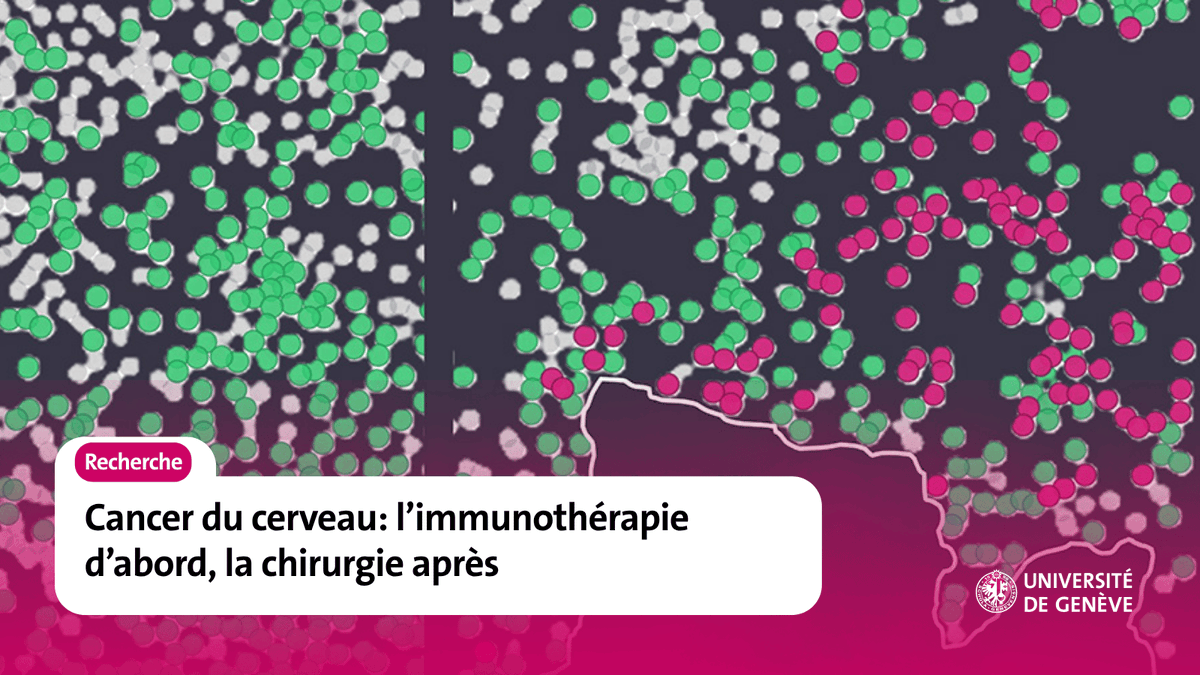 UNIGEnews's tweet photo. Une équipe de l’UNIGE et des @hug_ge montre qu’administrer une immunothérapie avant d'opérer une tumeur cérébrale est nettement plus efficace qu'après l'intervention. https://t.co/gaZrLfiAg4 https://t.co/gCl0sHGt7h