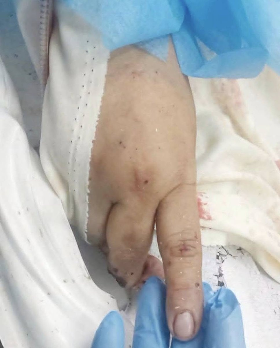 islamasalya88's tweet photo. Bu Gazzeli kadının adı Ümmü Muhammed el-Arabid’dir.

Dün siyonistlerden bir güç, eşini tutuklamaya çalıştı. Bunun üzerine eşini ve evini savunmak için silahını aldı. Kendisi ile Siyonist güç arasında doğrudan bir çatışma yaşandı. Onlardan ikisini vurup doğrudan öldürdü, ayrıca Siyonistlerden bazıları da yaralandı.

Bu anne yaralandı ve ardından şehit oldu. Aynı evde, damat olan oğlu da çok ağır yaralandı. Eşi ise büyük zorluklarla tutuklandı.

Eşi de silahındaki son mermiye kadar Siyonistlerle çatıştı.

İşte Filistinli anne böyledir; silahını eline alır, evini ve eşini korur, son mermisine, son nefesine kadar geri adım atmaz.

İşte Gazzeli anne; sabırdır, imandır, sebat ve direniştir. Evini, ailesini ve onurunu son ana kadar savunur.

Şehidemiz Ümmü Muhammed’e Allah rahmet eylesin..
