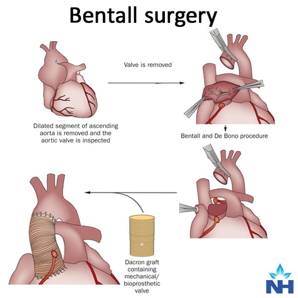 HiraaliCardio's tweet photo. The Bentall procedure 

⇒ Is a life-saving cardiac surgical operation that replaces a diseased aortic valve, aortic root, and ascending aorta using a pre assembled composite valve Dacron graft conduit. 
⇒ During the procedure the native aortic valve and dilated aneurysm tissue are resected, the artificial graft is sutured into place at the aortic annulus and the left and right coronary arteries are carefully mobilized and re implanted directly into the graft walls to restore myocardial blood flow