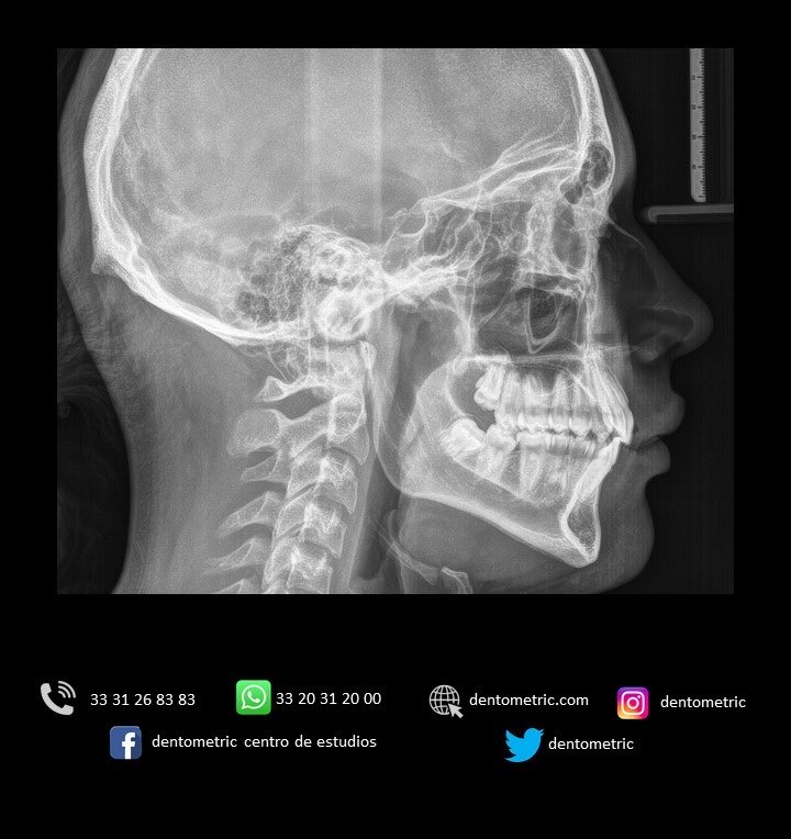 dentometric's tweet photo. La rx lateral de cráneo permite visualizar estructuras óseas de la cabeza, la cara y base del cráneo. Evalúa el perfil facial, la relación entre maxilar y mandíbula, fracturas en los huesos de la cara, malformaciones y afecciones en los huesos craneales. https://t.co/7k0e6unWFZ