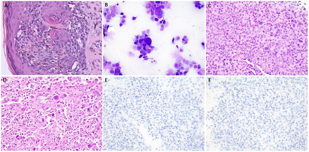 precisonco_MDPI's tweet photo. Discover in #PrecisionOncology!

"Metastatic Undifferentiated Melanoma with Ultra-High Tumor Mutational Burden and UV Mutational Signature: A Diagnostic Challenge"

🔗 https://t.co/xlDTvPHLh9

#Melanoma #TumorMutationalBurden #UVSignature #NF1Mutation #PD1Inhibitor #Immunotherapy https://t.co/q2zIzeB7A3