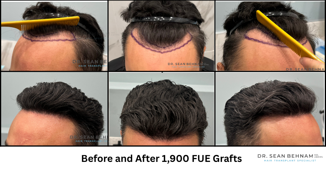 IGetHair's tweet photo. 1,900 FUE Grafts at the hairline by Dr. Sean Behnam
#HairTransplant #FUE #FUEHairTransplant #HairRestoration #HairTransplantResults https://t.co/I71mZLZsxU