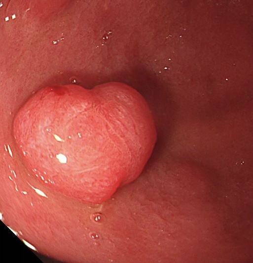 drkeithsiau's tweet photo. A heart-shaped gastric polyp seen on endoscopy. Sometimes, the best way to a man’s heart is through the stomach ❤️😜 https://t.co/0EfeI4kB38