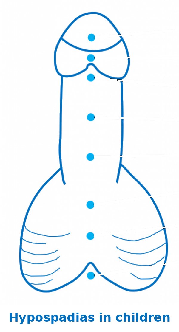 amerix's tweet photo. HYPOSPADIAS is a condition in which the URETHRA (the tube that carries urine) of a baby boy opens on the underside of the penis instead of the tip.

RISK and CAUSATIVE FACTORS:

When the mother is,

• Conceiving at 35 years and above

• Having diabetes during pregnancy

• Exposed to pesticides, herbicides and endocrine disruptors

• Obese

• Smoking

• Alcoholic

• Eating bad diet, inflammatory foods

• Swallowing fertility drugs eg Ovacare