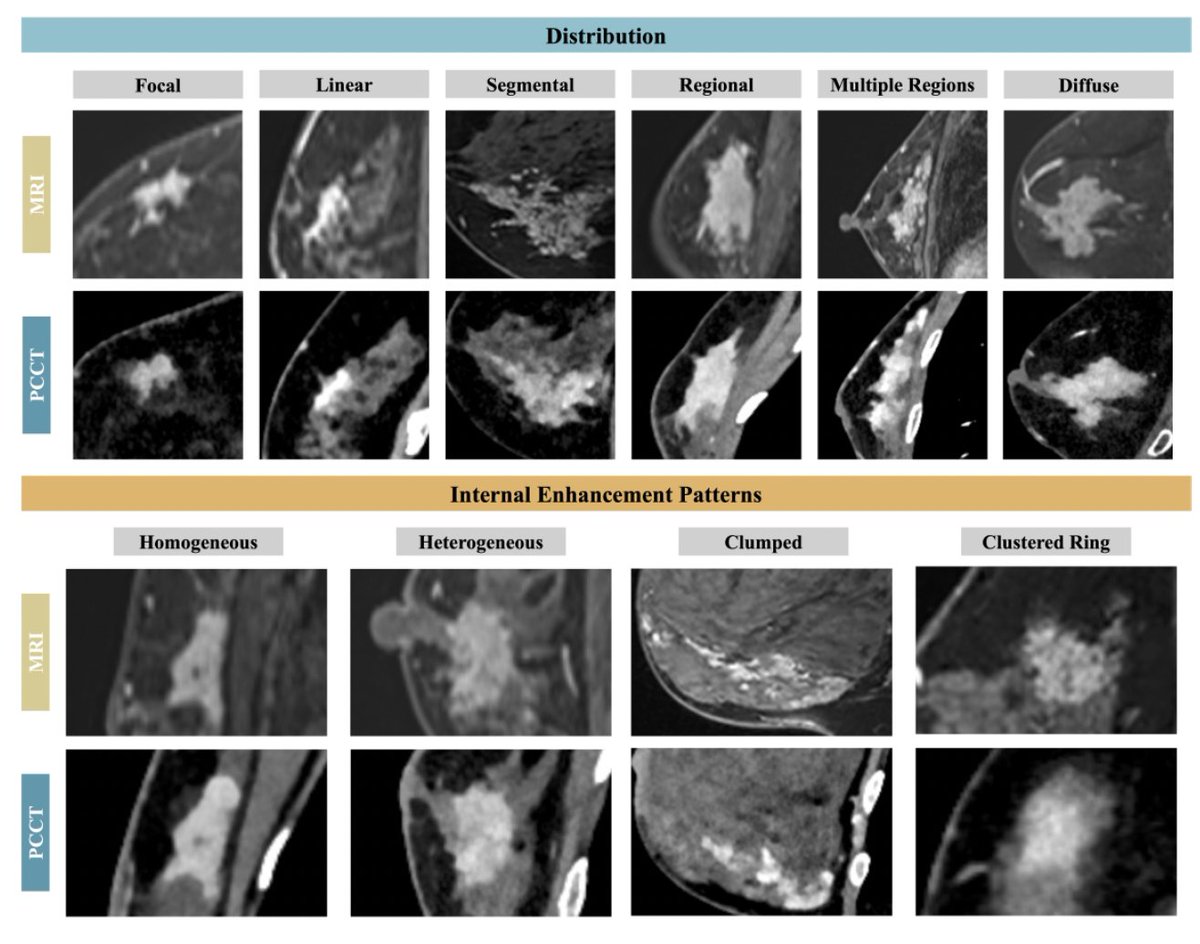 Maryamfotouhi11's tweet photo. 1/10 Can #PhotonCountingCT (PCCT) combine local #BreastCancer staging + regional nodal assessment in one exam?
๐ in @Radiology_RSNA: prospective comparison of PCCT with mammo, MRI & 18F-FDG PET/CT
#RadInTraining #Tweetorial https://t.co/jxcQt1PibN
