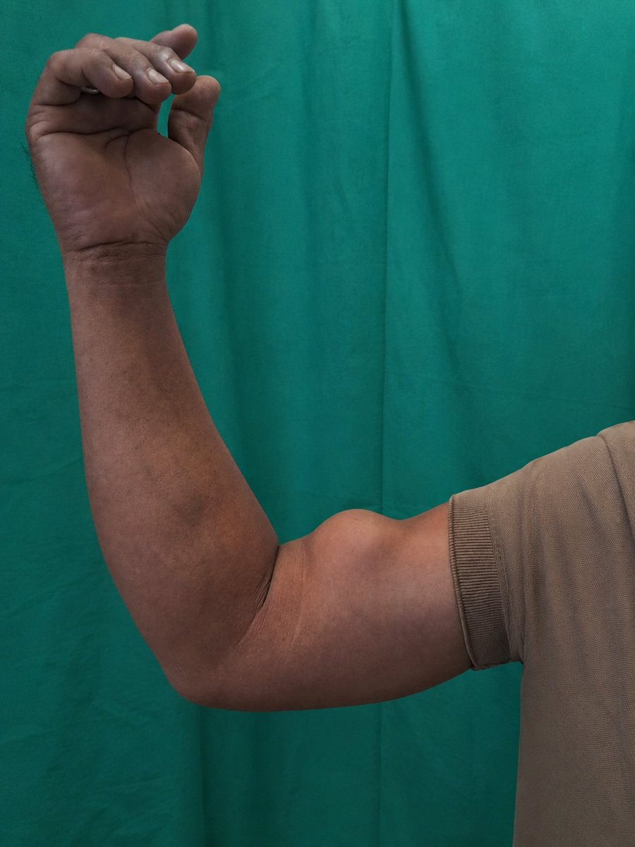 Drsumankrroy's tweet photo. 34 yrs/male with a history of trauma presented to the OPD with a characteristic bulge of the biceps muscle. The clinical picture demonstrates a positive “Popeye sign.”
Diagnosis: Proximal long-head biceps tendon rupture.
#ClinicalCase #BicepsRupture #PopeyeSign https://t.co/ys1KlZ8NNR