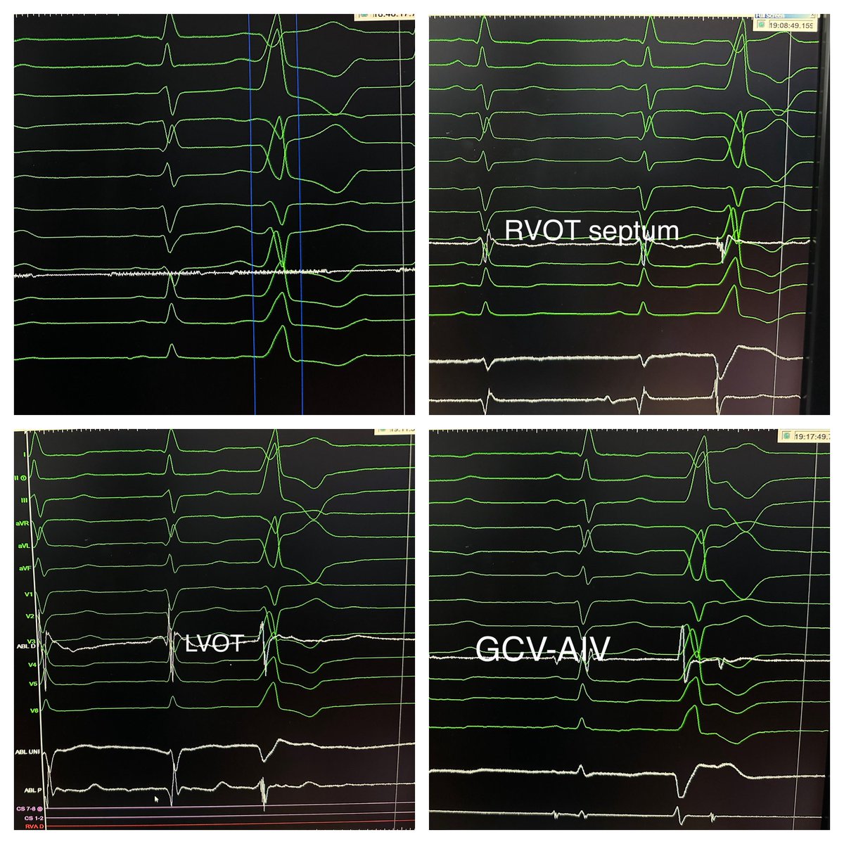 javadm20's tweet photo. LV summit’s PVC’s with ATV3 & just 10 ms early from RVOT/LVOT and a little bit better in GCV-AIV! with anatomical approach from LV Endo ; start slow VT then cleared from L-R C. #Epeeps https://t.co/5IVpU9GnGe
