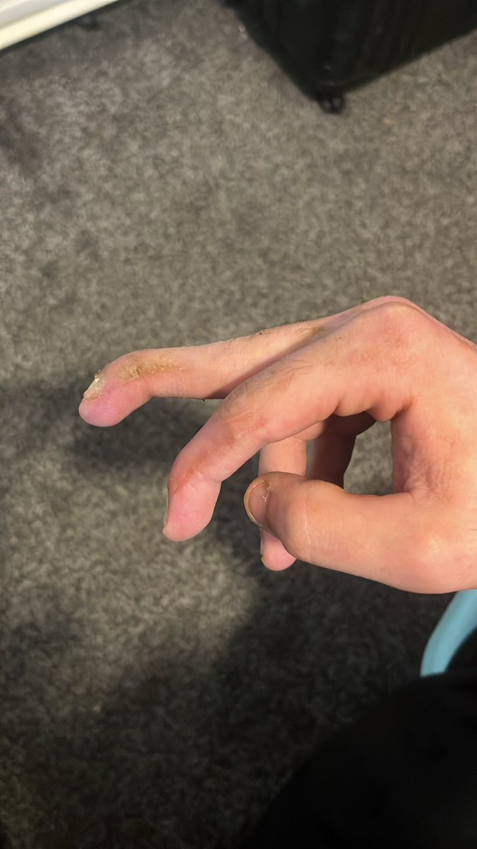 tondorsam's tweet photo. After a long 6 months recovery I’m finally able to return to work… 
Worst year of my life get my life back together now 👌🏻 https://t.co/8453uGPFvl