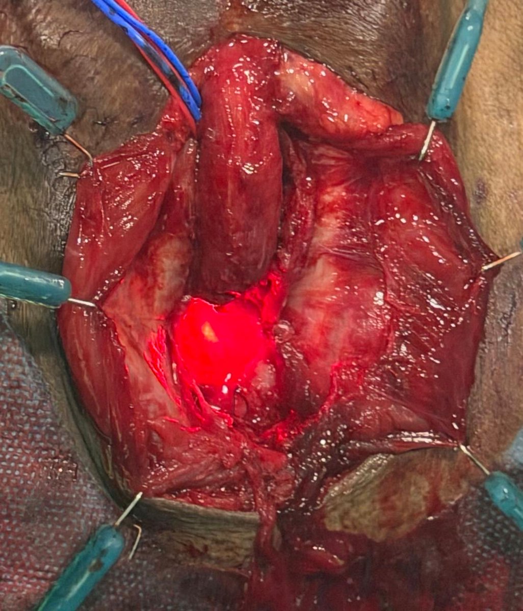PrajwalPaudyal's tweet photo. During Pelvic Fracture Urethral Injury (PFUI) reconstruction, using an antegrade flexible cystoscope is a critical technique to precisely localize the proximal limit of a completely obliterated or severely strictured urethra. https://t.co/xb7cxpvzqR