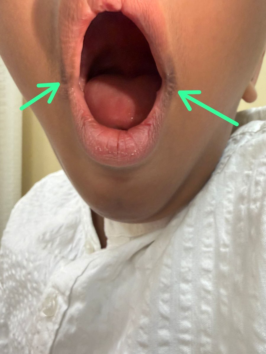 PediatricsC_1's tweet photo. Oozing and painful since 9 months back , suggest a treatment? https://t.co/hWLy5TShnT