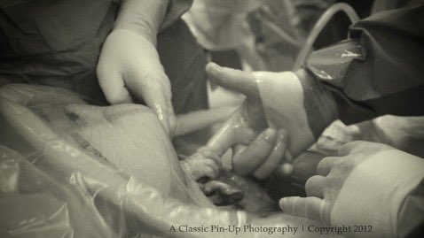 StudentsforLife's tweet photo. POV: The "clump of cells" just grabbed the surgeon’s finger. https://t.co/MtEBhCgWdW