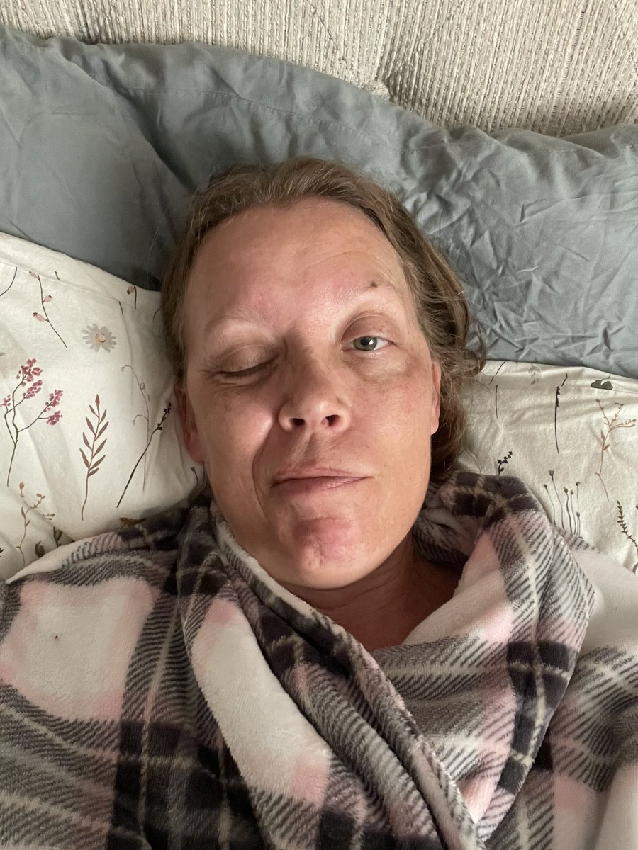 CarrieSak's tweet photo. 6 days until The Allison Inquiry.5 days out from traveling to Ottawa to present on Day 1 of the Allison Inquiry on Parliament Hill,and this is the reality.
I’m currently dealing with a heavy flare-up. My face is constantly spasming, and the pain in my head is intense. Living with a vaccine injury means your body doesn't care about calendar dates or important milestones. It’s an unrelenting daily battle, even when preparing for major national platforms.
Despite the physical wallop today, my determination hasn't shifted. Stories like mine,and so many others across Canada need to be documented publicly and honestly. We need accountability, recognition, and proper care.
Thank you to everyone standing with me, supporting my journey. I’ll keep you all updated as I make my way to Parliament Hill.
@DeanAllisonMP 
@Shawnbuckleylaw 
@AllisonInquiry