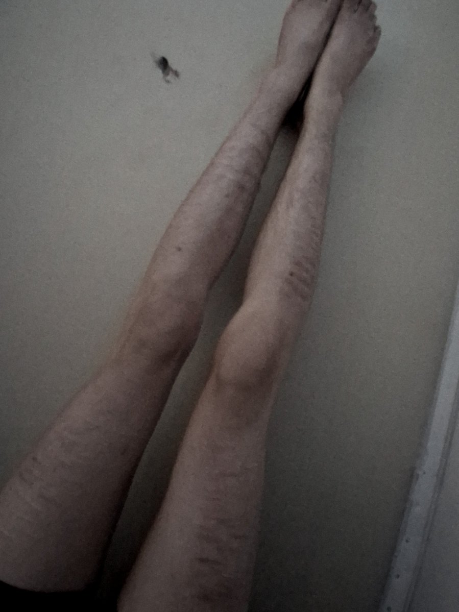 WingsHaveRot's tweet photo. Why are my thighs so huge at bmi 15.8? I know it's not that low or anything but I'm still so LARGE I take up so much space I hate it https://t.co/4XGox5u0qy
