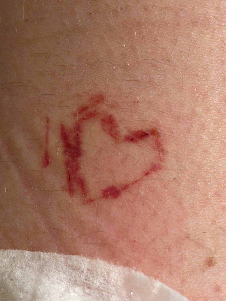 username6094838's tweet photo. Why it look like dat? #beans #fascia #sh #shtwt #laffytaffy #shed #shedtwt #drugtwt #edrtwt #ana #cutspo #cuts #styro #suicide #suicidetwt #razor #blood #slit #slice #scars #shscar #selfharm #selfharmscar #stitches #scarspo #thinspo #wl #weightloss #ana #gore #scar #toxic https://t.co/KjOvPzbFAY