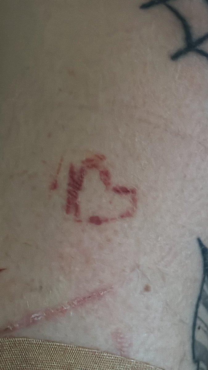 username6094838's tweet photo. Why it look like dat? #beans #fascia #sh #shtwt #laffytaffy #shed #shedtwt #drugtwt #edrtwt #ana #cutspo #cuts #styro #suicide #suicidetwt #razor #blood #slit #slice #scars #shscar #selfharm #selfharmscar #stitches #scarspo #thinspo #wl #weightloss #ana #gore #scar #toxic https://t.co/KjOvPzbFAY
