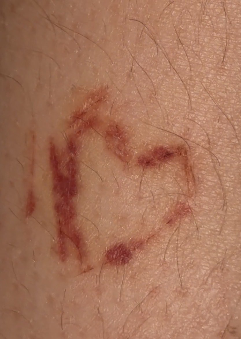 username6094838's tweet photo. Why it look like dat? #beans #fascia #sh #shtwt #laffytaffy #shed #shedtwt #drugtwt #edrtwt #ana #cutspo #cuts #styro #suicide #suicidetwt #razor #blood #slit #slice #scars #shscar #selfharm #selfharmscar #stitches #scarspo #thinspo #wl #weightloss #ana #gore #scar #toxic https://t.co/KjOvPzbFAY