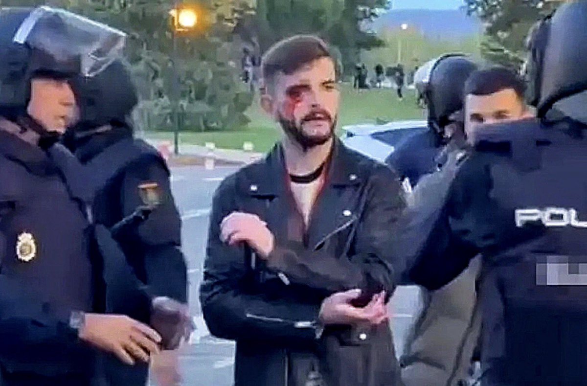 Albertopugilat's tweet photo. Cuando los antifascistas de Navarra dejaron así a este periodista de El Español, ninguno se indignó y defendieron a sus agresores.

Ahora os jodéis y mamáis https://t.co/QEFXSvVI5H