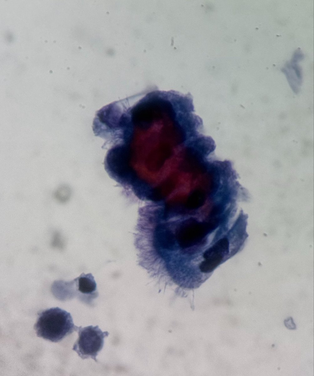 PathologyKate's tweet photo. How did these ciliated epithelial cells end up in the pelvic washing?
#Boardfodder https://t.co/OCdCX91kd7