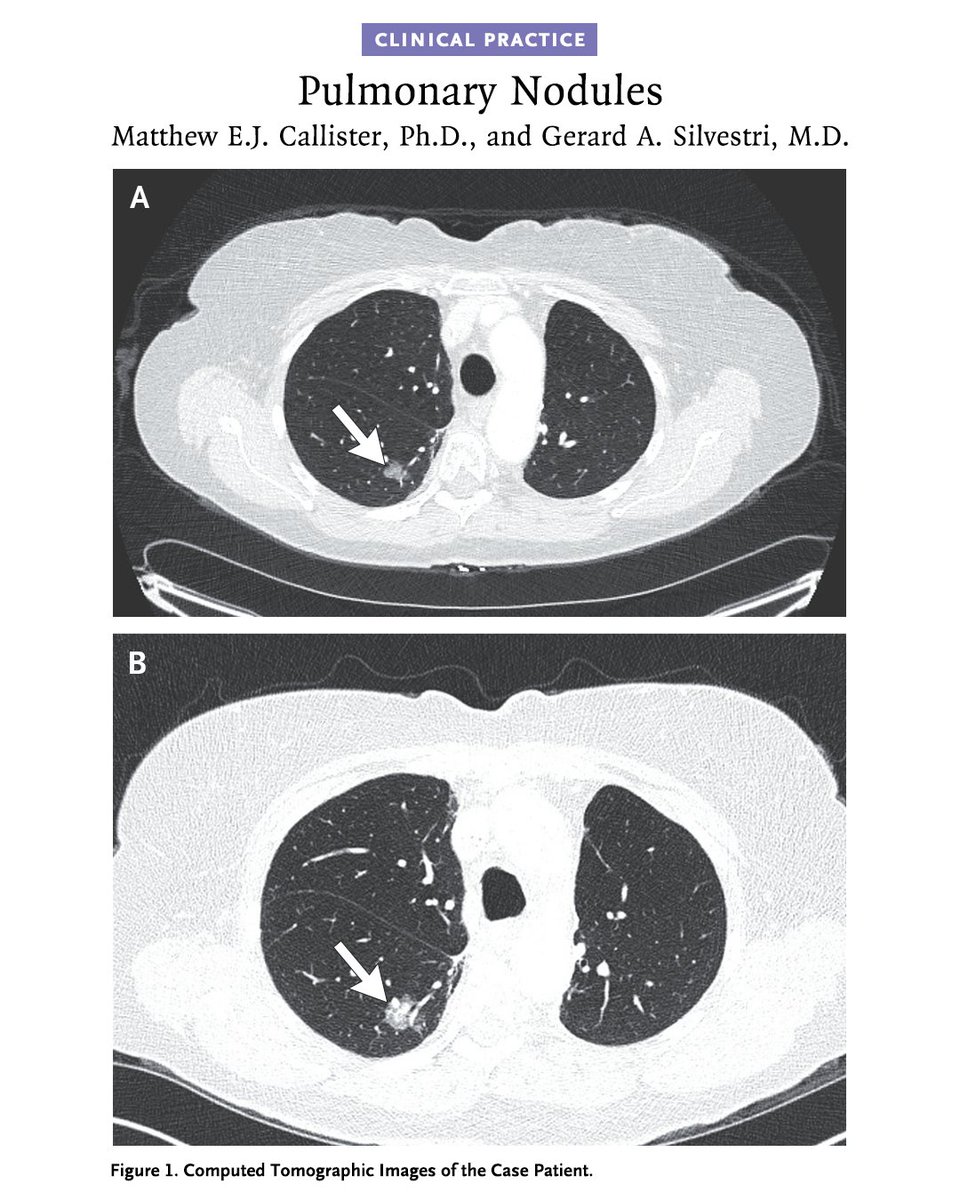 NEJM's tweet photo. A new Clinical Practice article summarizes the management of pulmonary nodules, with an emphasis on nodule type, imaging follow-up, cancer risk, and strategies to balance timely diagnosis with avoidance of unnecessary procedures. 

Read “Pulmonary Nodules” by Matthew E.J. Callister, PhD, and Gerard A. Silvestri, MD: https://t.co/zb8xCMfODs