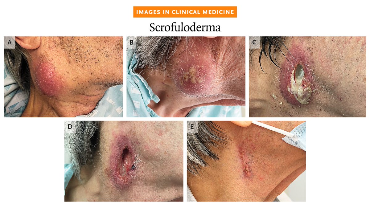 NEJM's tweet photo. A 72-year-old man presented with a 2-month history of a painful lump on his neck. Cytologic analysis of fine-needle aspirate was consistent with suppurative lymphadenopathy. The lesion subsequently ulcerated and released purulent discharge. 

Read the full case details in the Images in Clinical Medicine article “Scrofuloderma”: https://t.co/KPfP3m2ZCO
